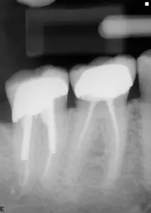 endodontic retreatment pre-op