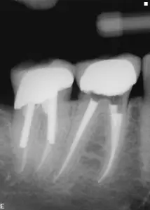 Endodontic retreatment