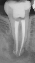 X-ray of an infected tooth in need of root canal retreatment