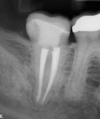Digital X-ray taken at Endodontic Specialists in Fishers
