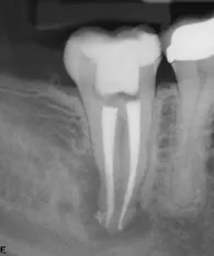 Digital X-ray taken at Fishers, IN Endodontic Specialists