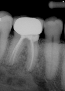 post op 30