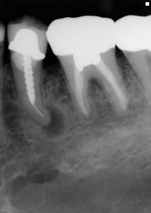 dental recall case