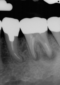 dental recall case Fishers